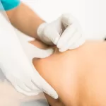 Understanding the Differences Between Dry Needling and Acupuncture